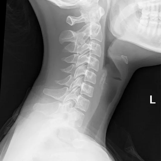 X-ray Soft Tissue Neck AP View